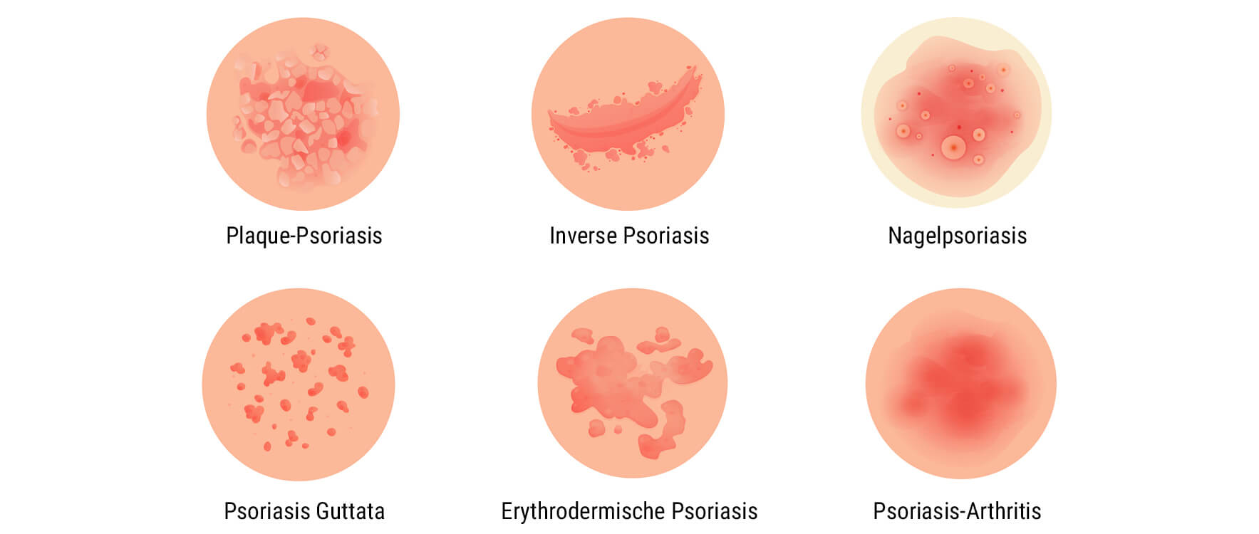 Was ist Psoriasis?