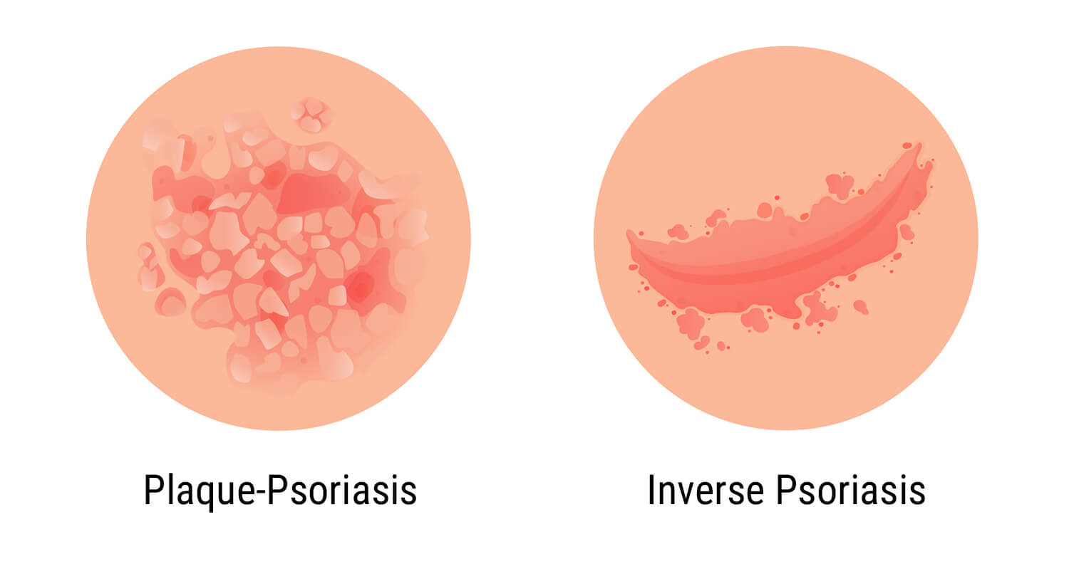 Was ist Psoriasis? Was ist Psoriasis?