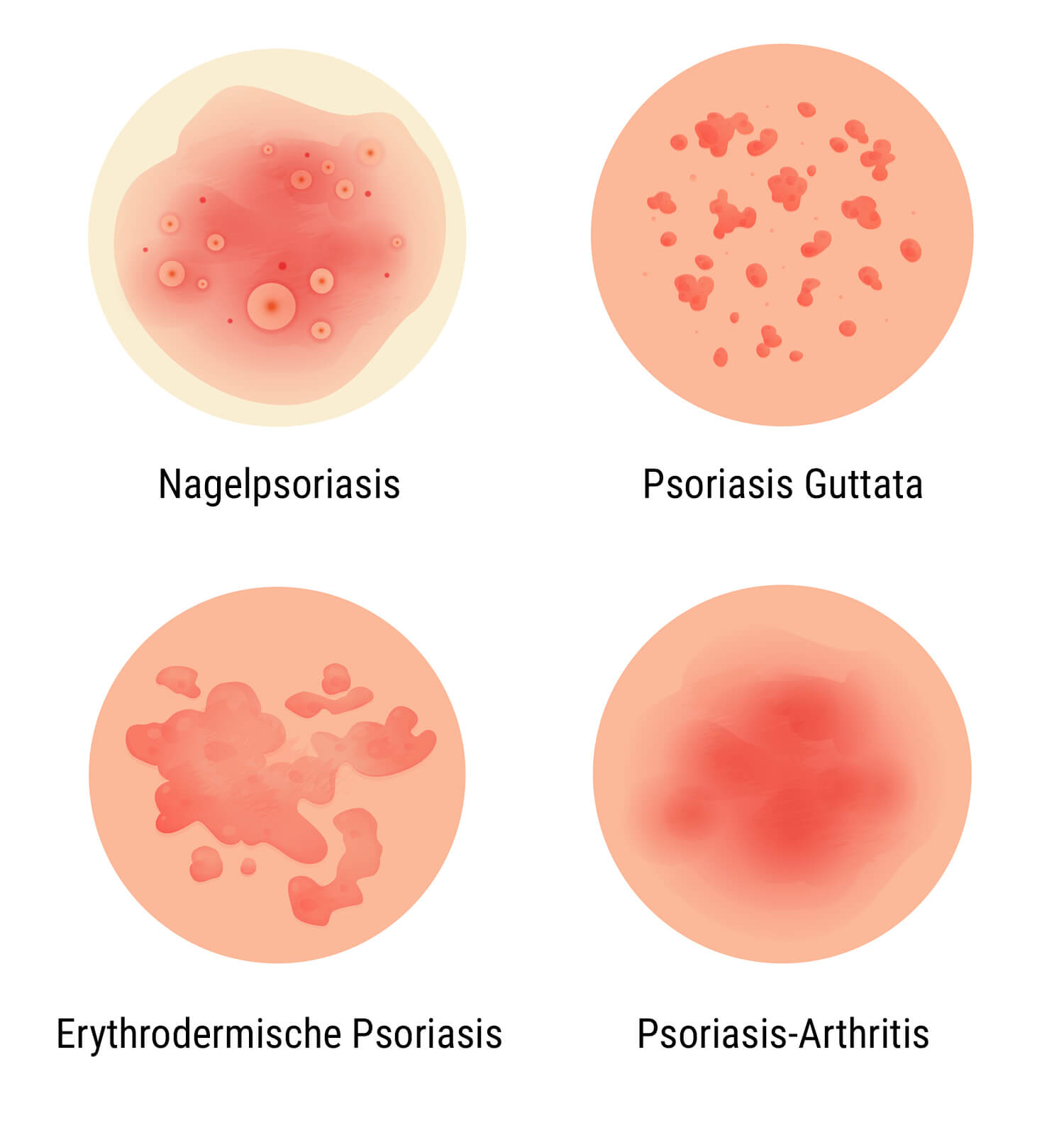 Was ist Psoriasis? Was ist Psoriasis?