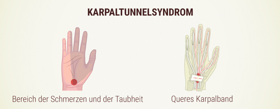 Carpal Tunnel Syndrom