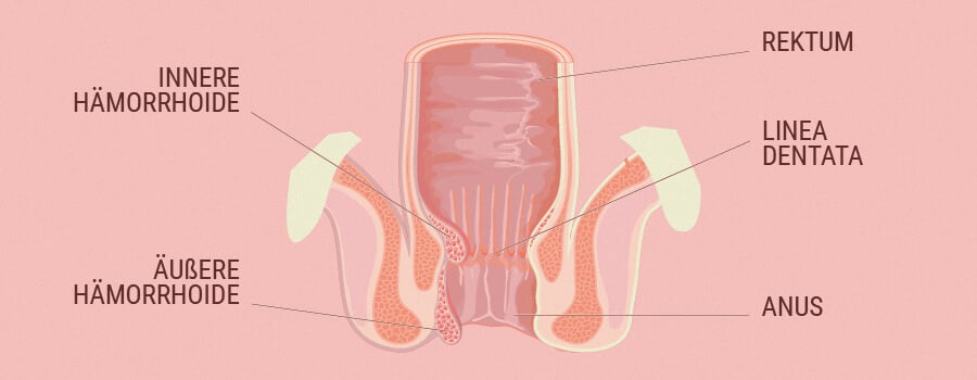 Die Verbindung zwischen dem ECS und Hämorrhoiden