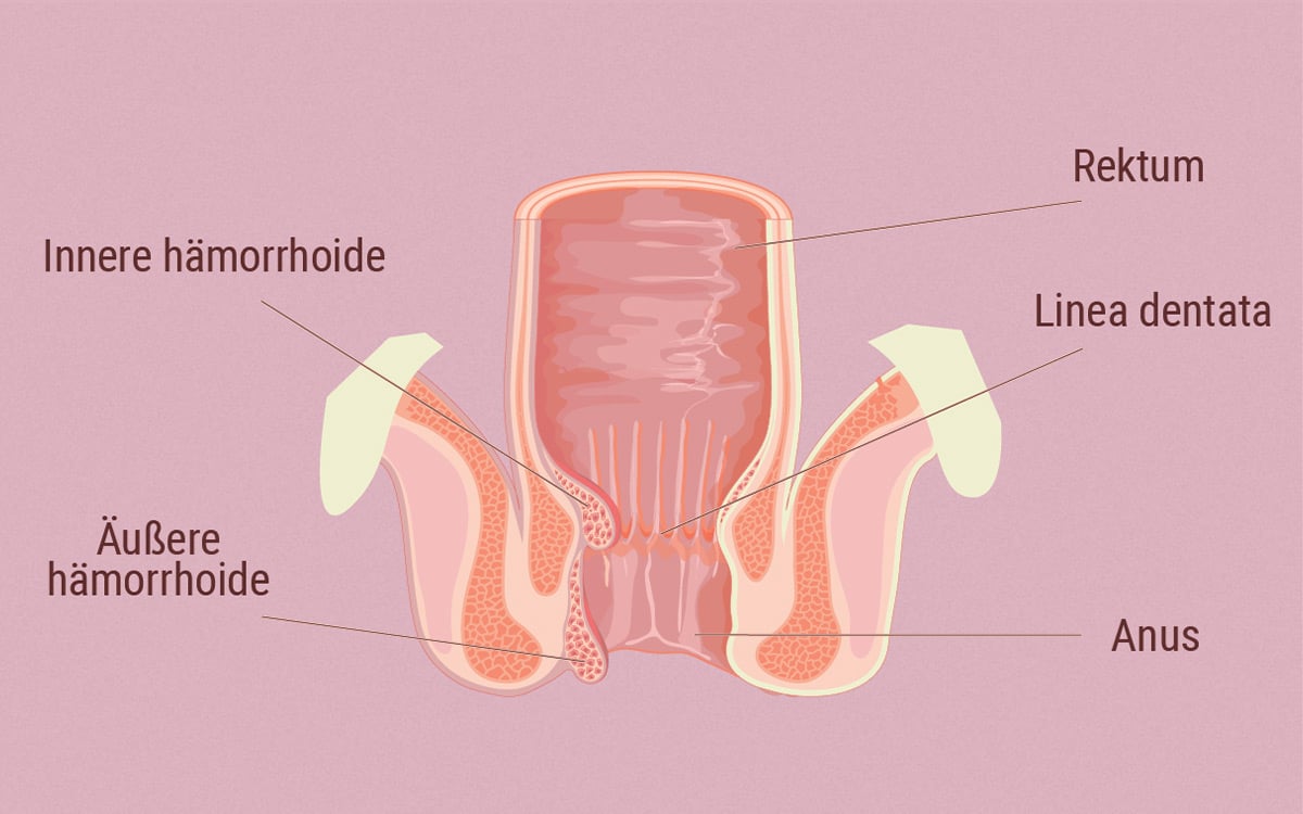 Die Verbindung zwischen dem ECS und Hämorrhoiden