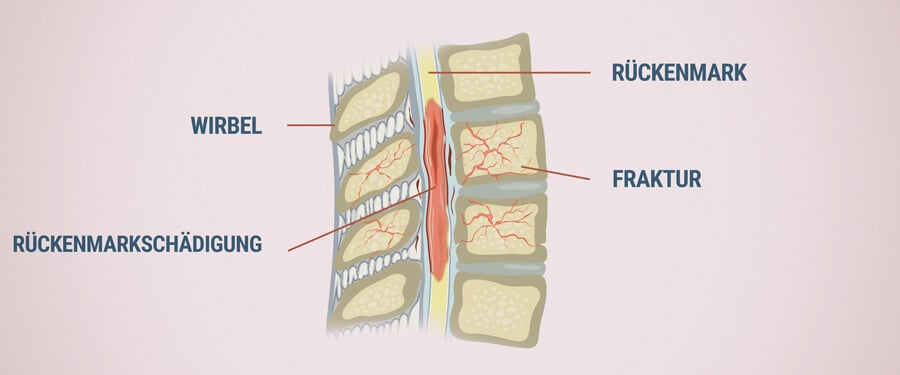 Schaden am Rückenmark