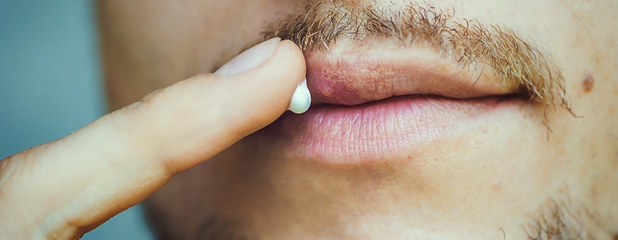 Cannabisbehandlung für Herpes Cannabisbehandlung für Herpes