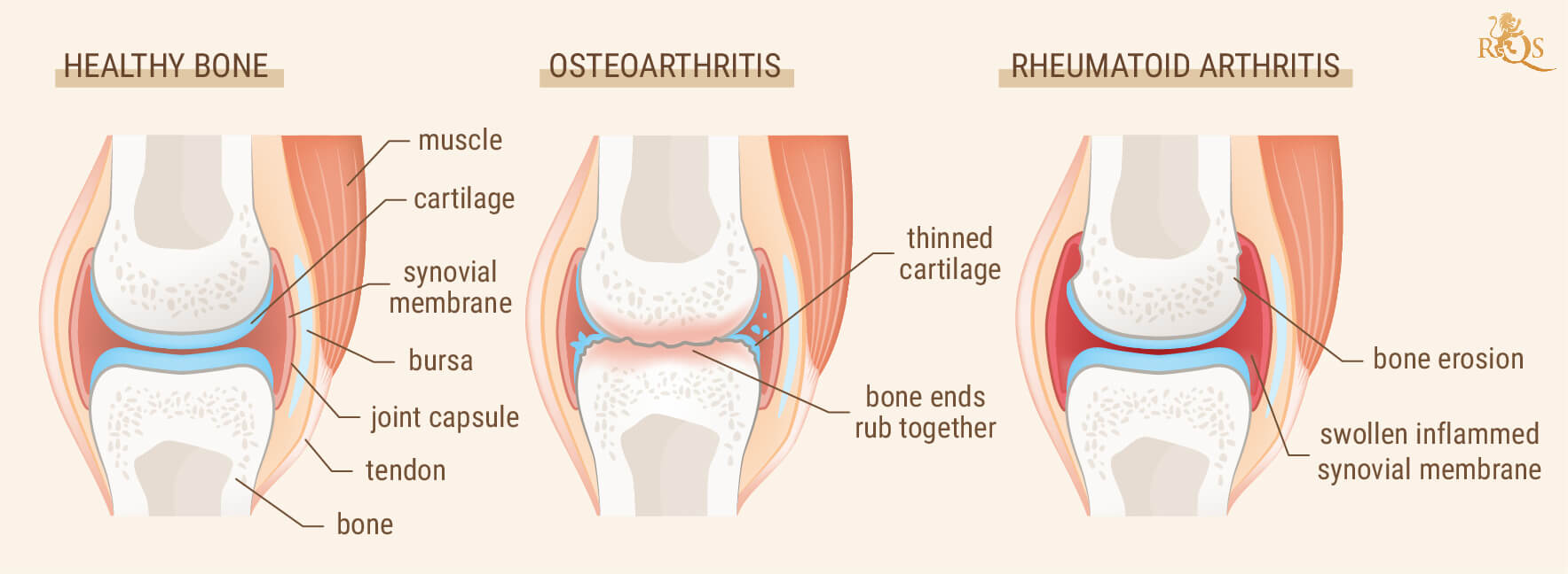 Sind Arthritis und Rheuma das Gleiche?