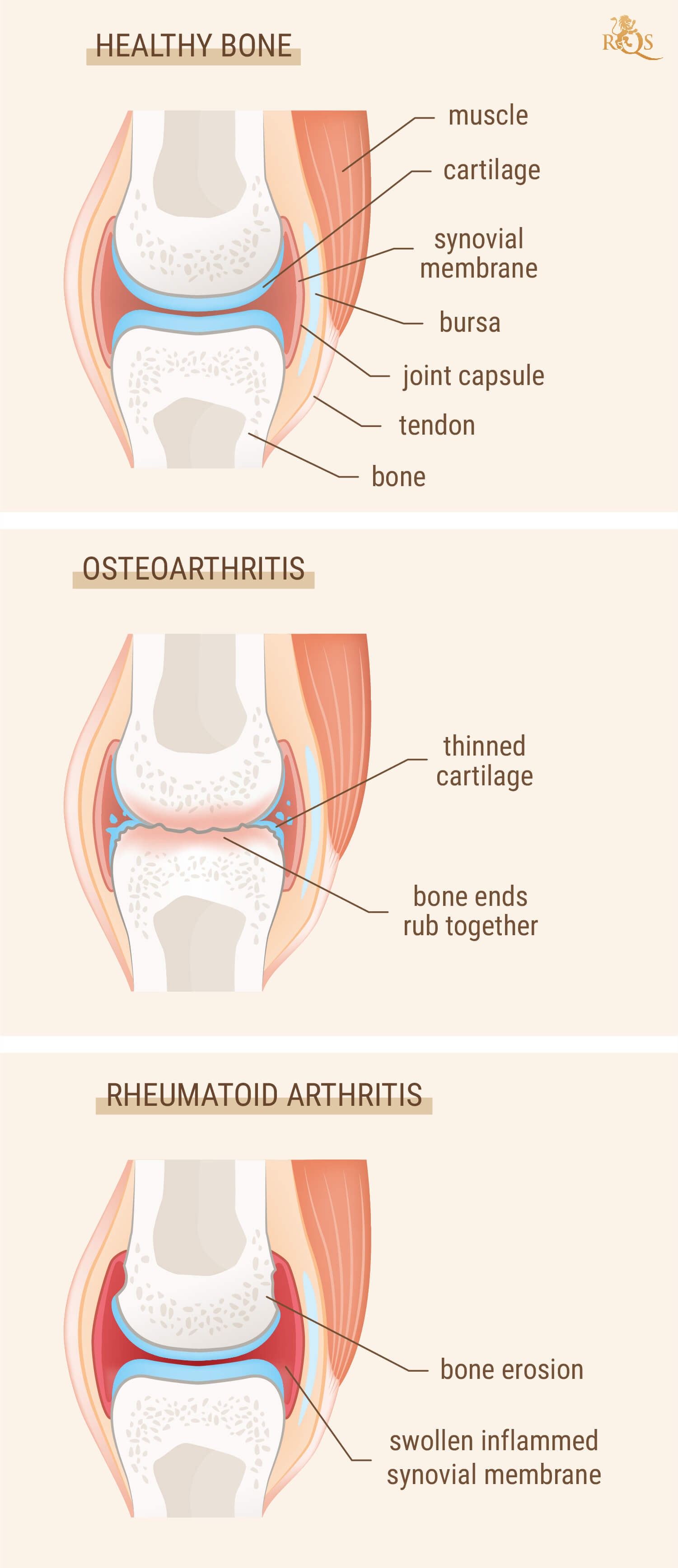 Sind Arthritis und Rheuma das Gleiche?