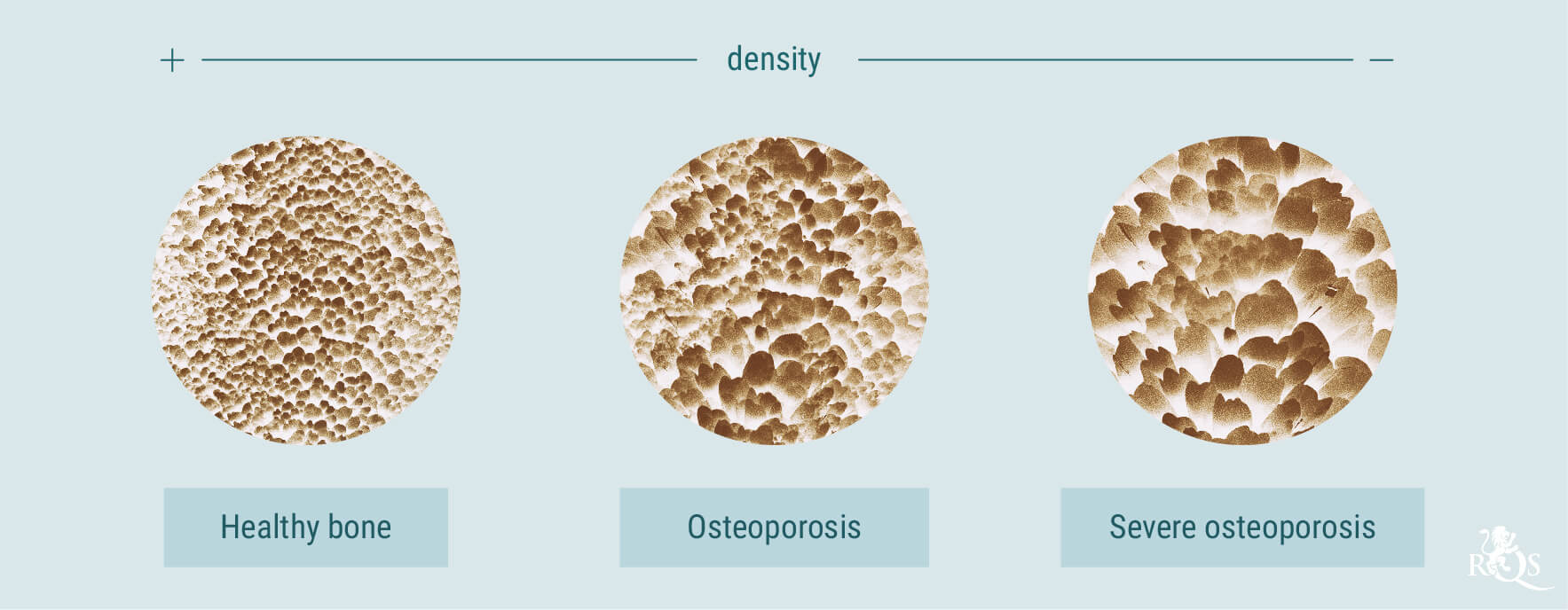 Cannabis und Osteoporose