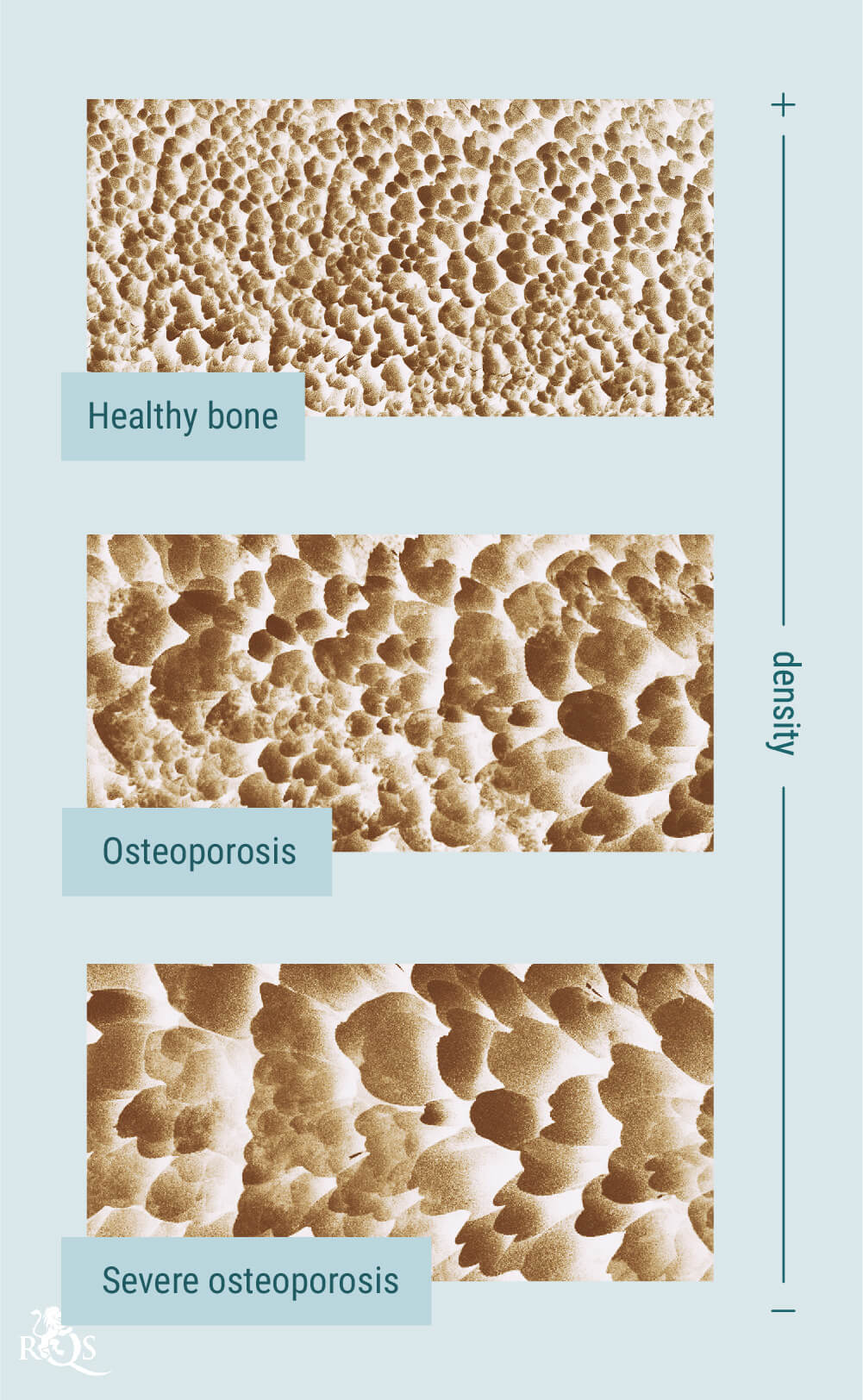 Cannabis und Osteoporose