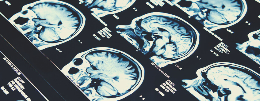 CBD und Epilepsie CBD und Epilepsie