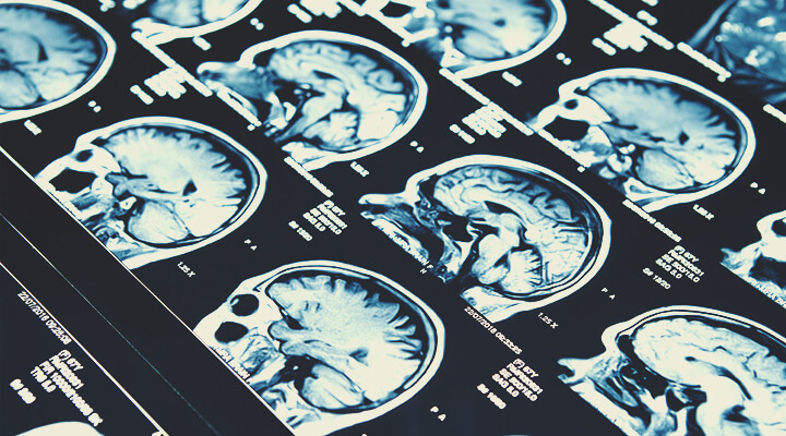 CBD und Epilepsie CBD und Epilepsie
