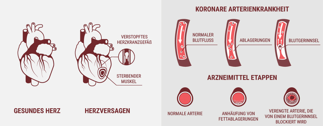 Sind Herz-Kreislauf-Erkrankungen und Herzerkrankung dasselbe?