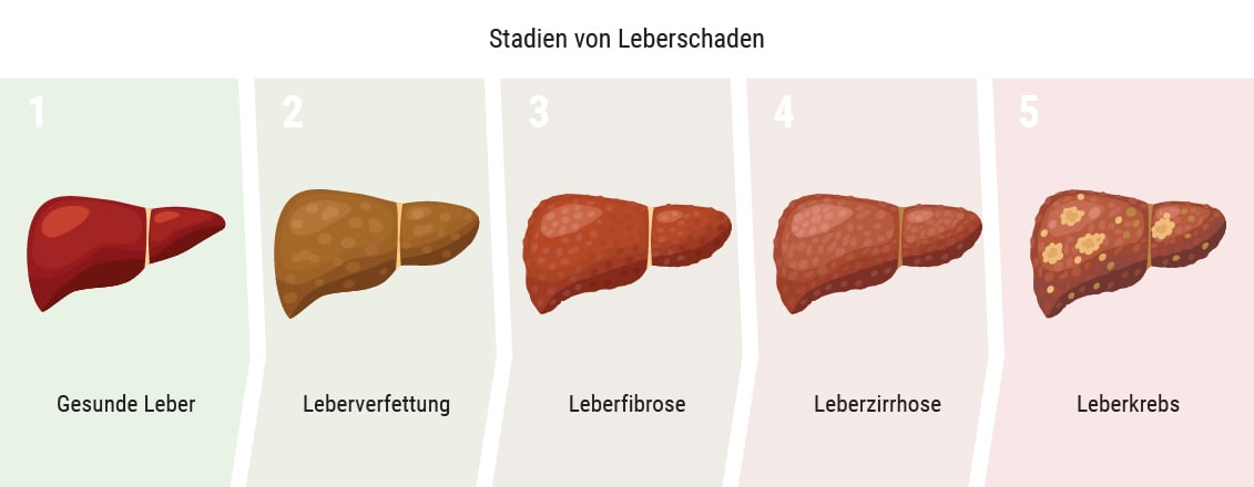 Beeinflusst Cannabis die Leber?