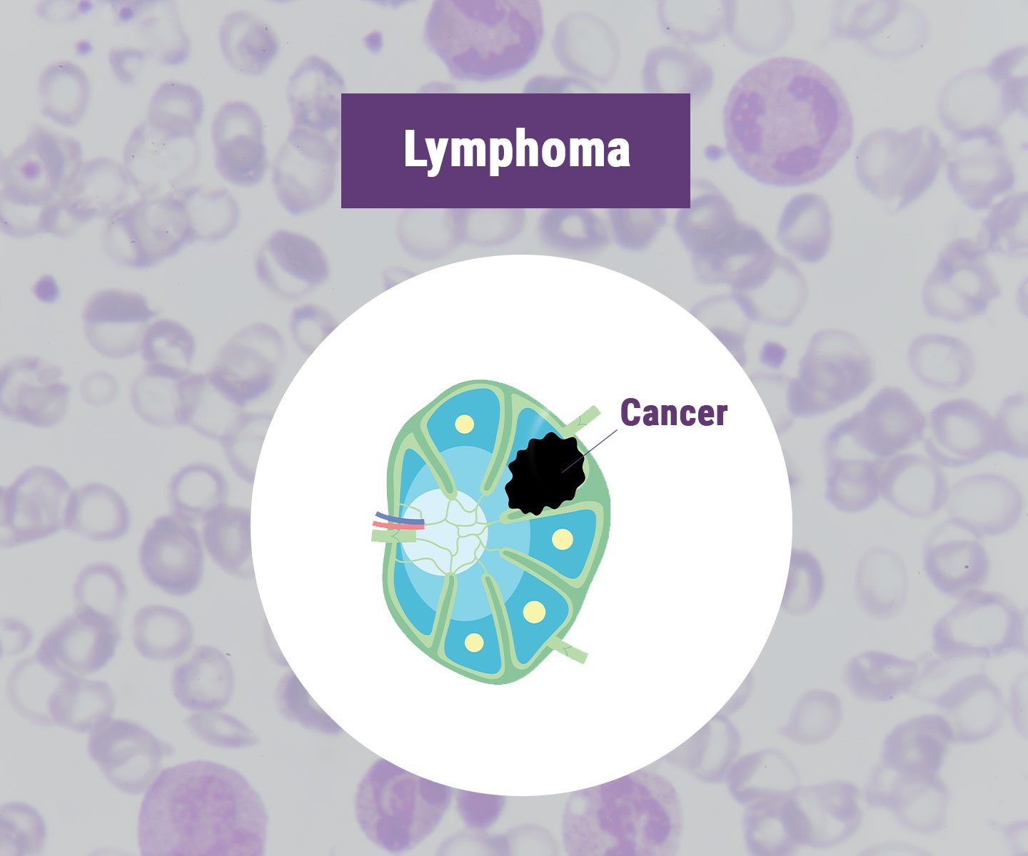 Lymphom