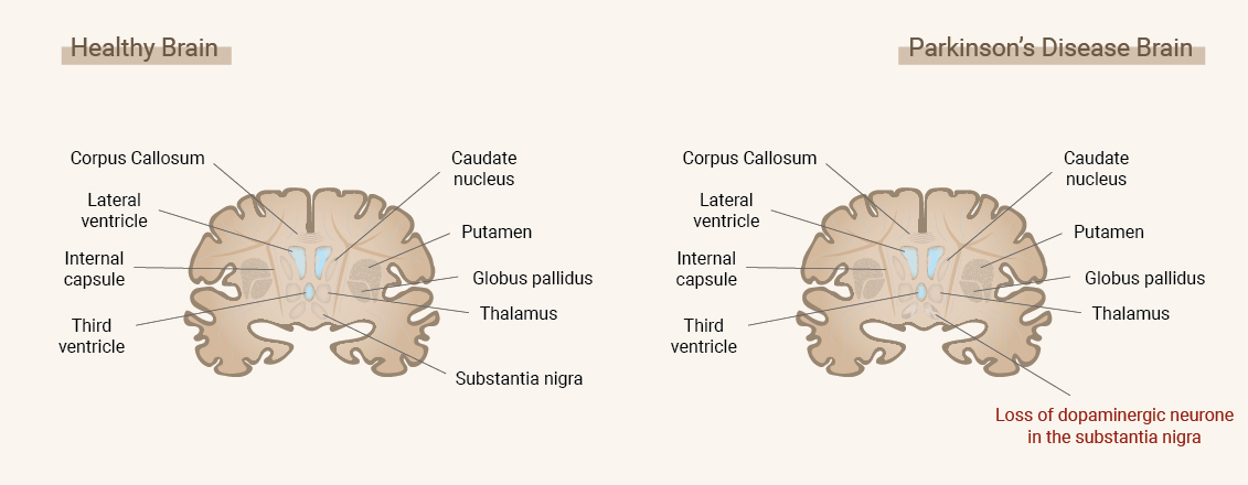 Was ist Parkinson? Was ist Parkinson?