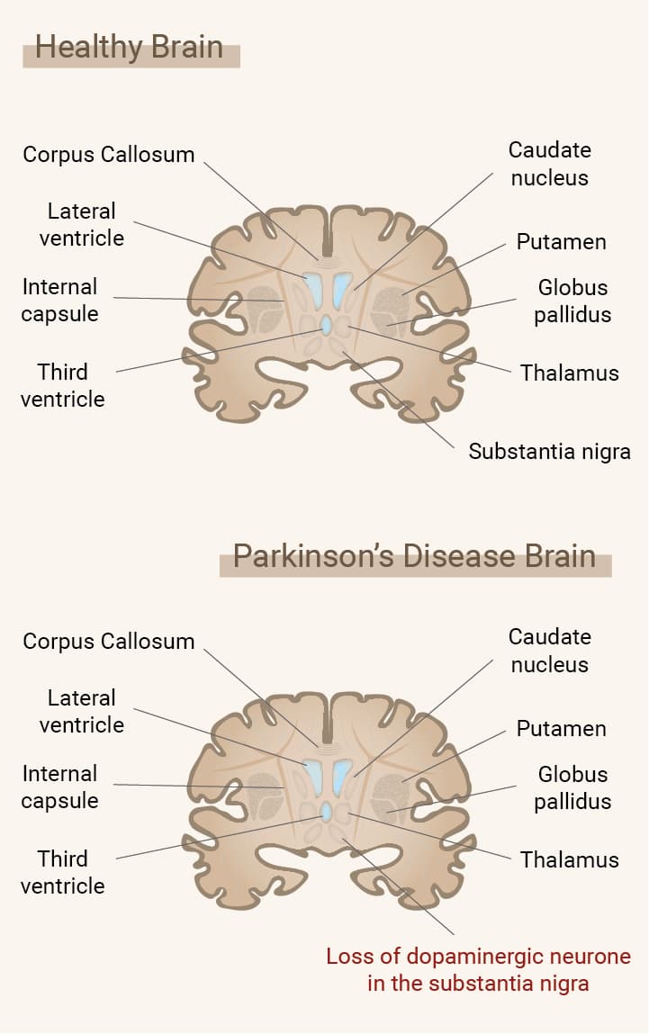 Was ist Parkinson? Was ist Parkinson?
