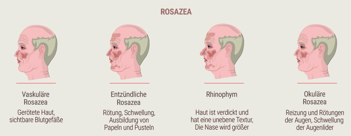 Was ist Rosazea?