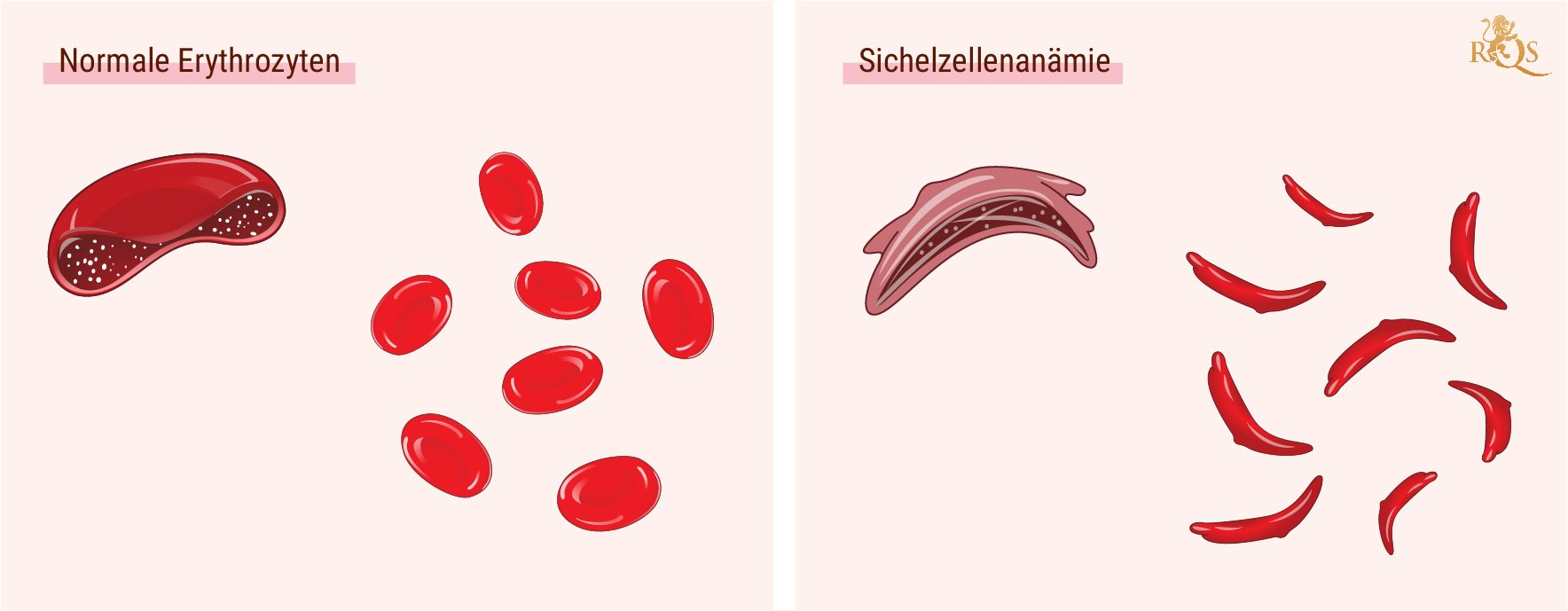 Was ist Sichelzellenanämie?