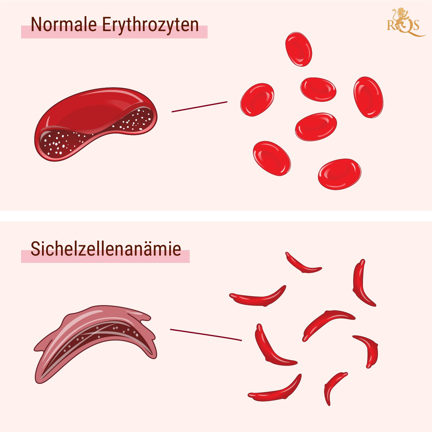 Was ist Sichelzellenanämie?