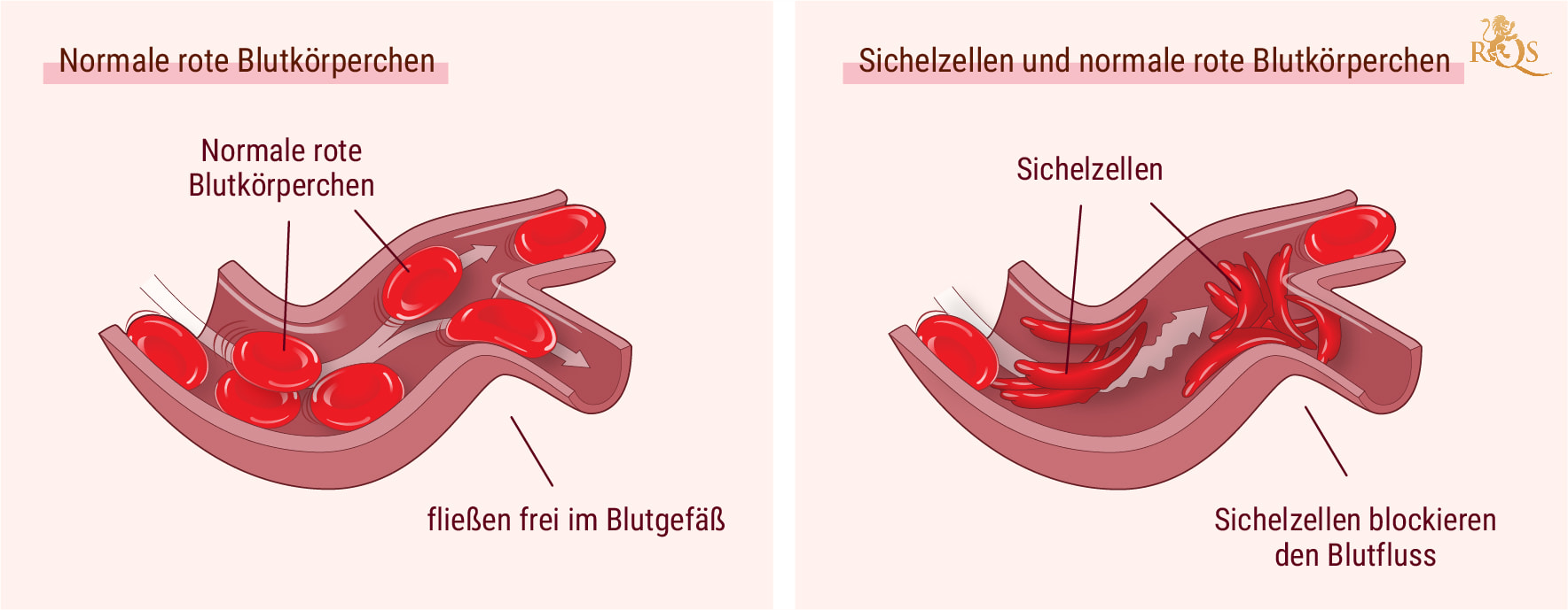 Cannabis und die Symptome von Sichelzellenanämie