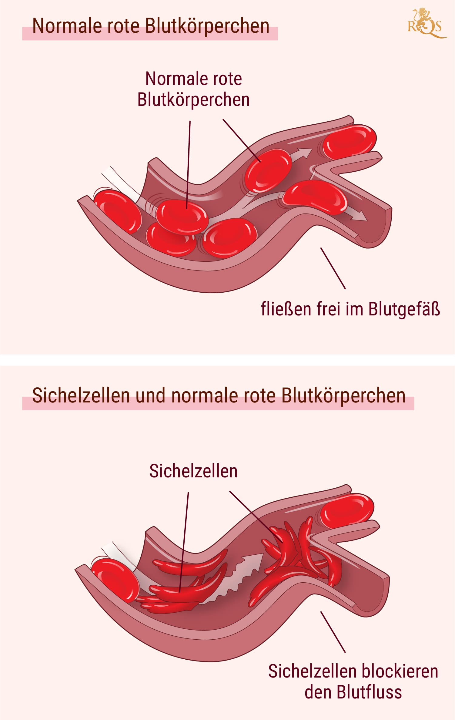 Cannabis und die Symptome von Sichelzellenanämie