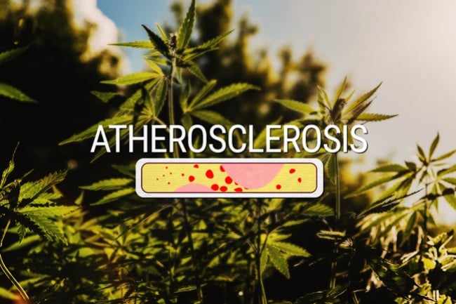 Kann Cannabis wirksam Arteriosklerose behandeln?